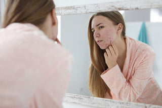 Sunscreen Tips for Acne-Prone Skin: Expert Advice from Dr. Bottiglione